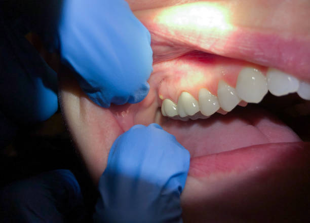 Best Knocked-Out Tooth Emergency  in Millersville, PA